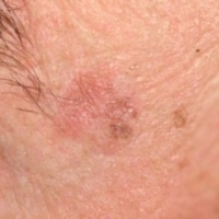 ESTATE : ATTENTI ALLA CHERATOSI ATTINICA