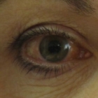 La vista può volare via. Previeni il glaucoma